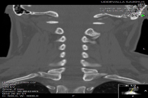 Eine MRT-Aufnahme des Halses eines Mannes mit einem Bruch, die auf einem Computerbildschirm angezeigt wird und die Größe, Form und Lage des Bruchs zeigt.